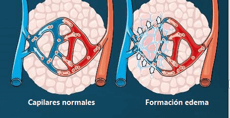 Formación del edema