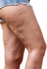 piernas con celulitis blanda celulitis blanda