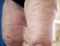 celulitis edematosa 2 celulitis edmatosa