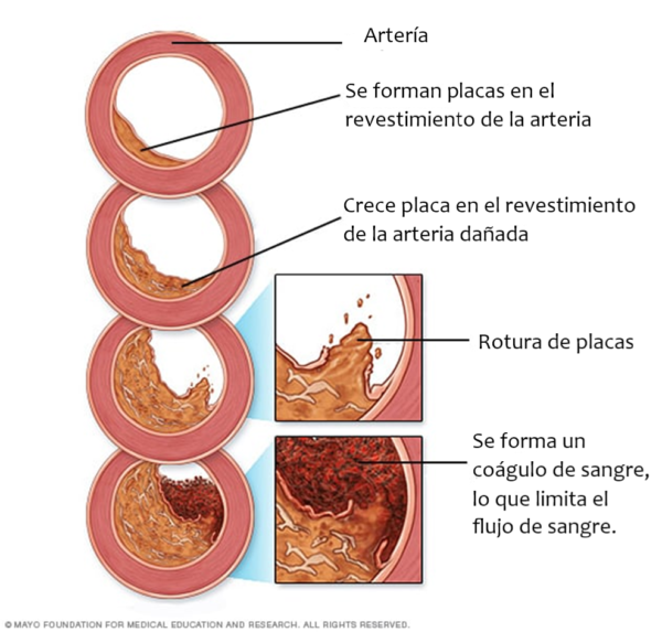 Colesterol alto, ¿qué es?